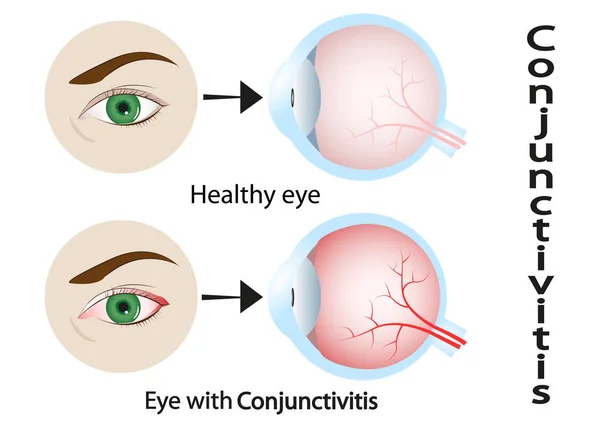 Conjunctivitis. Red Eye. Human Eyeball With Conjunctivitis. Vector Illustration — Stock Vector