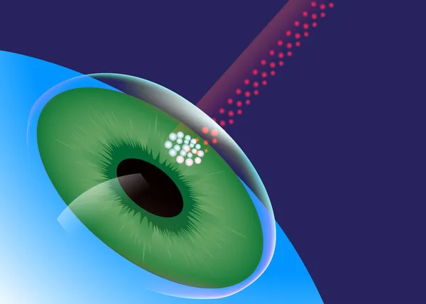 LASIK, Centre des yeux, Chirurgie des yeux au laser — Image vectorielle