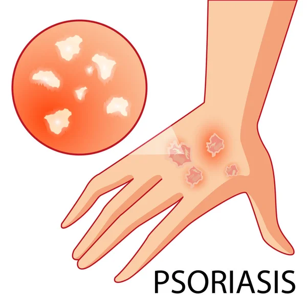 Psoriasis. Huidproblemen. Vector. Cartoon. Geïsoleerd. Flat. Illustratie voor websites, brochures, tijdschriften. Geneeskunde. — Stockvector