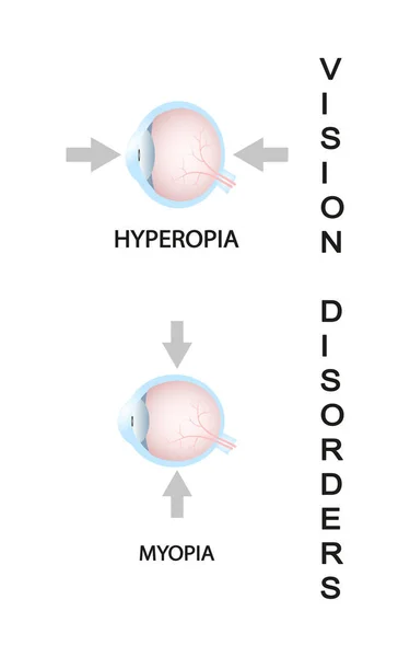 Myopie et myopie corrigées par une lentille négative. Trouble de la vision . — Image vectorielle