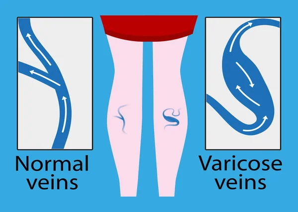 Vektor vena varicose dan vena normal. Kaki wanita yang ramping dan indah. Vena Varicose . - Stok Vektor