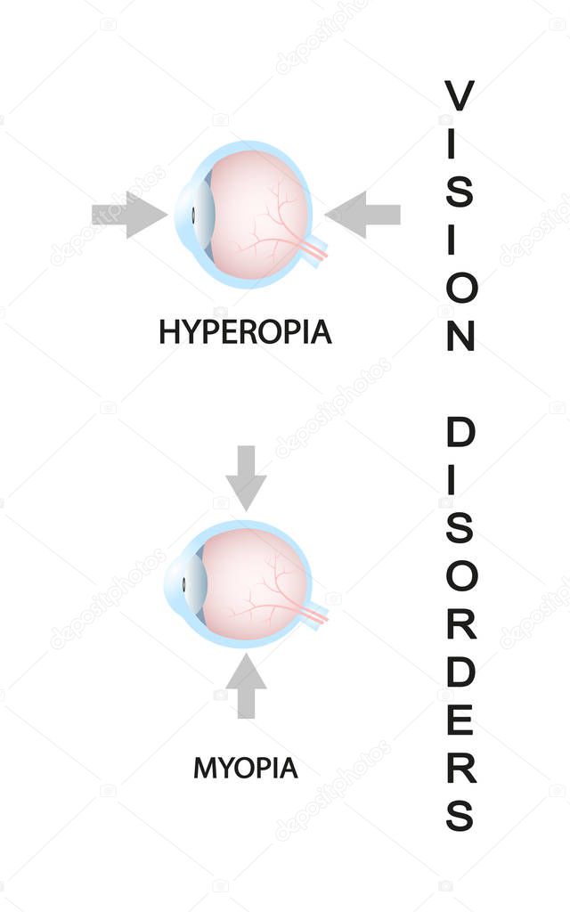 Myopia and myopia corrected by a minus lens. Eye vision disorder.