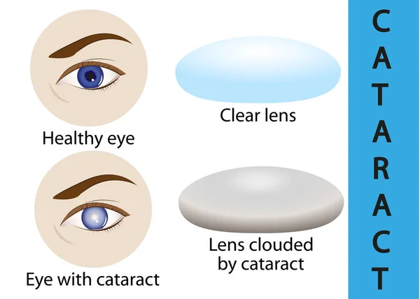 Una catarata es una lente cristalina nublada dentro del ojo . — Vector de stock