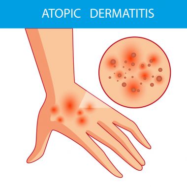 Atopik dermatis. Kişi Atopik dermatit olan kol çizikler. Kaşıntı. Bir deri lezyonu, kaşıntılı cilt renkli vektör çizim.