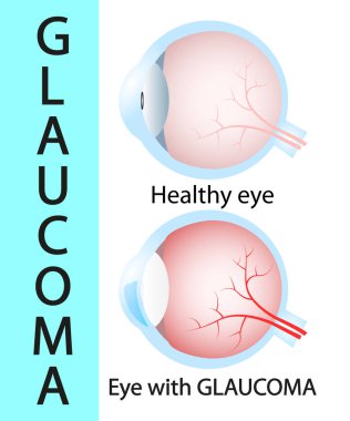 Glokom ve sağlıklı göz yapısı ayrıntılı.