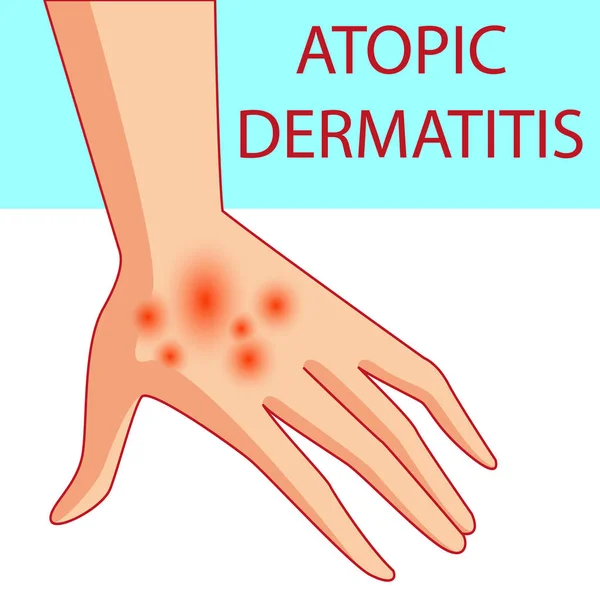 Dermatis atópicas. A pessoa coça o braço no qual é dermatite atópica. Comichão. Ilustração vetorial colorida de uma lesão de pele, comichão na pele . — Vetor de Stock
