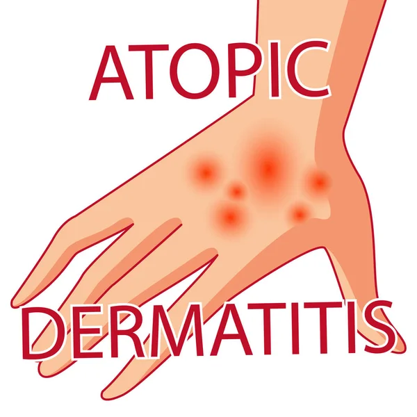 Dermatis atópicas. A pessoa coça o braço no qual é dermatite atópica. Comichão. Ilustração vetorial colorida de uma lesão de pele, comichão na pele . —  Vetores de Stock