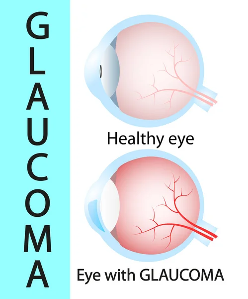 Glaucome et oeil sain structure détaillée . — Image vectorielle