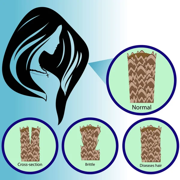 Folículo capilar. Corte transversal, quebradiço, perda, cabelo de doenças — Vetor de Stock