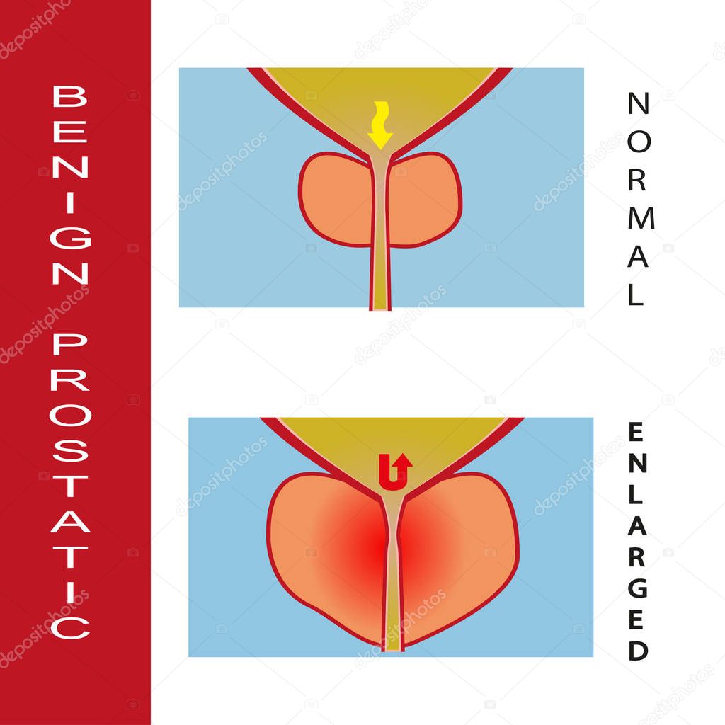 Benign prostatic hyperplasia, vector illustration (for basic medical education, for clinics & Schools)