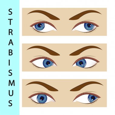 Strabismus strabismus,  eye,  illustration,  disorder,  movement,  ophthalmologist, clipart