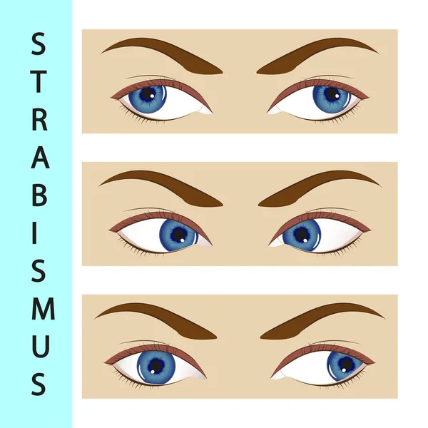 Strabismus strabismus, oko, ilustrace, porucha, pohyb, oftalmolog, — Stockový vektor