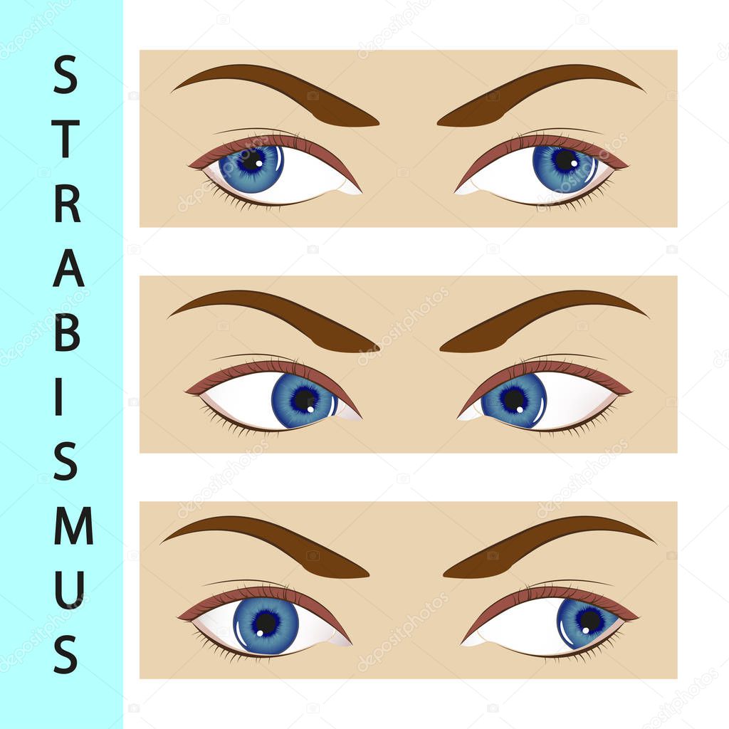 Strabismus strabismus,  eye,  illustration,  disorder,  movement,  ophthalmologist,