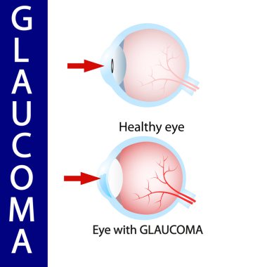 Glokom göz, basınç, optik, sinir, körlük,  