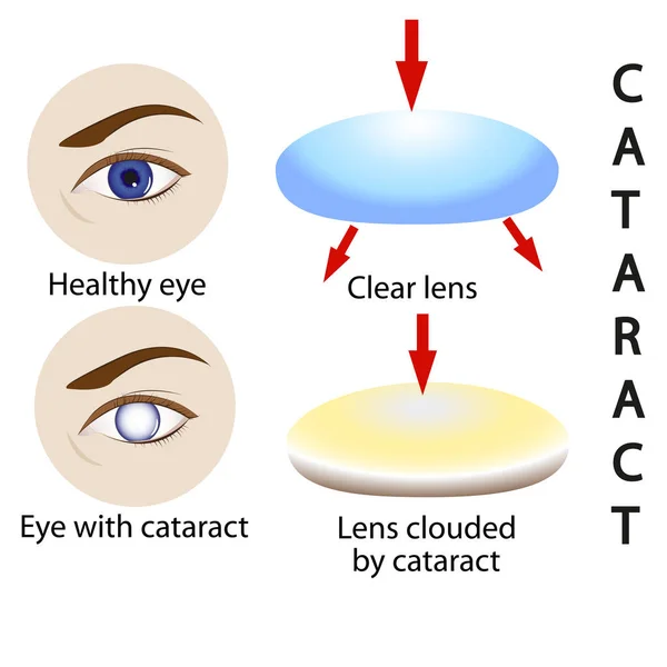 Cataracte santé, science, médical, oeil, vision, lentille, chirurgie , — Image vectorielle