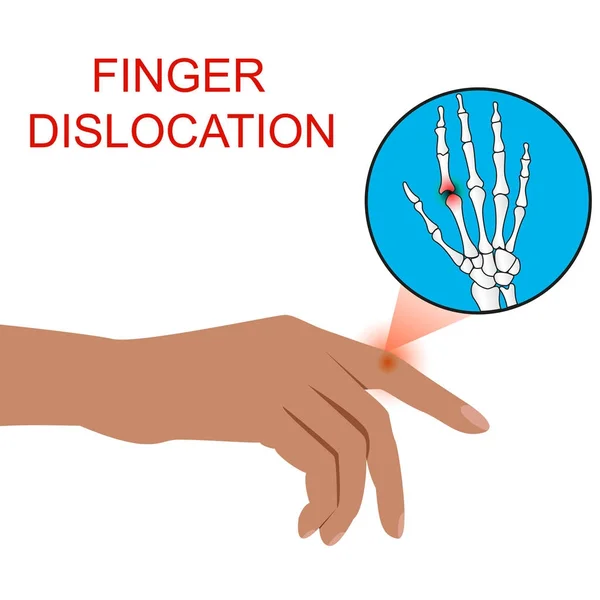 Deslocamento de dedos humano vetor de órgãos médicos ilustratio . — Vetor de Stock