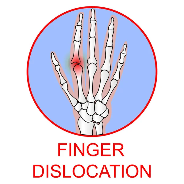 Deslocamento de dedos humano vetor de órgãos médicos ilustratio . — Vetor de Stock