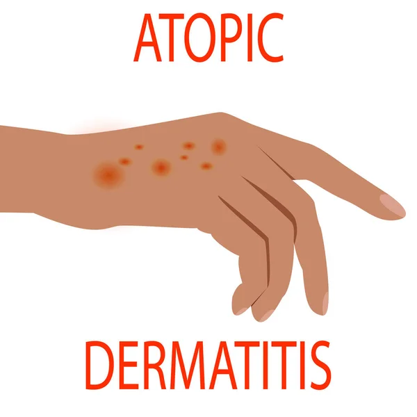 Atópiás dermatitis egészségügyi, orvosi, bőr, fájdalom, dermatitis, ekcéma, — Stock Vector