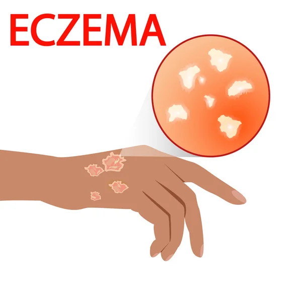 Eczema pele, tratamento, doença, dor, alergia, dermatologia — Vetor de Stock