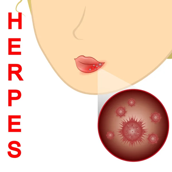 Herpes salute, donna, umano, cura, medico, medicina, raffreddore , — Vettoriale Stock