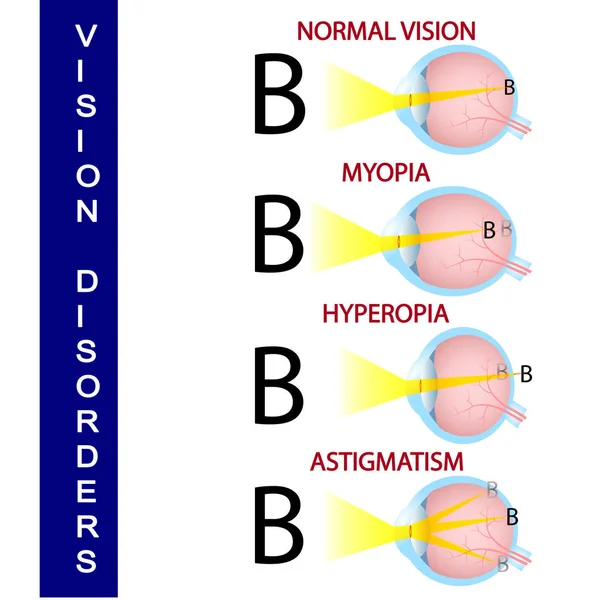 Trastornos de la visión humana, ciencia, ojo, visión, anatomía, enfermedad, órgano , — Archivo Imágenes Vectoriales