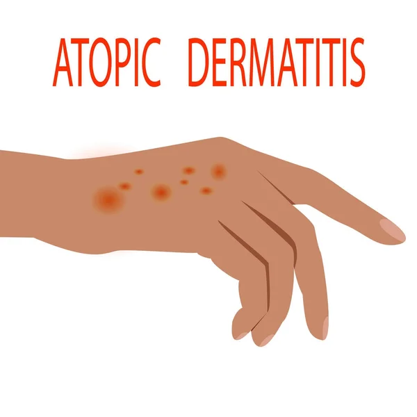 Dermatitis atópica salud, médico, piel, dolor, dermatitis, eczema , — Vector de stock