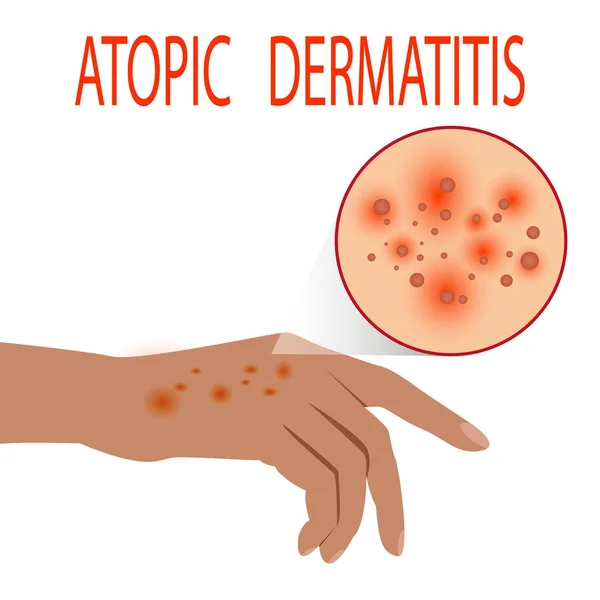 Dermatite atopique santé, médical, peau, douleur, dermatite, eczéma , — Image vectorielle