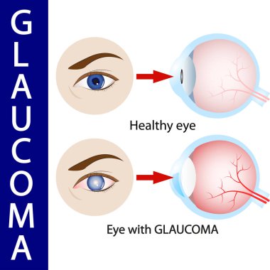 Glokom göz, basınç, optik, sinir, körlük,  