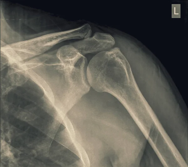 骨折した鎖骨前ビューを持つ40歳の男性患者の肩のX線 — ストック写真
