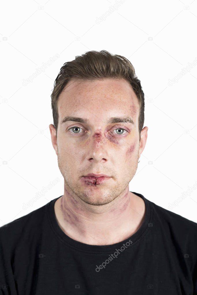 Portrait of young male victim of domestic violence with injured face