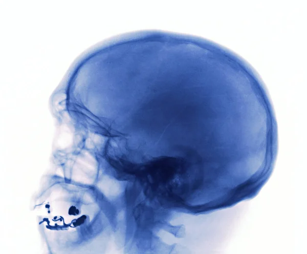 頭蓋骨骨折のX線 — ストック写真