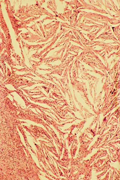 Cholesterinkristalle aus Mastitis der Brust — Stockfoto