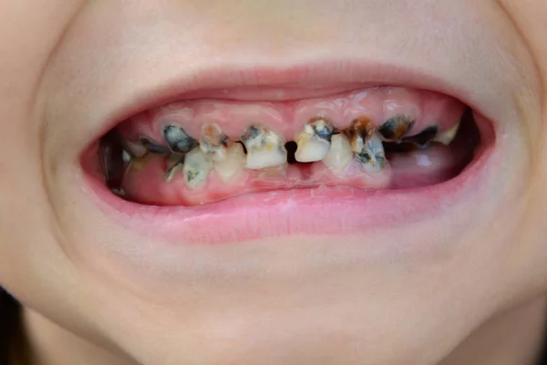 Dientes Niños Con Caries Dientes Enfermos Del Niño — Foto de Stock