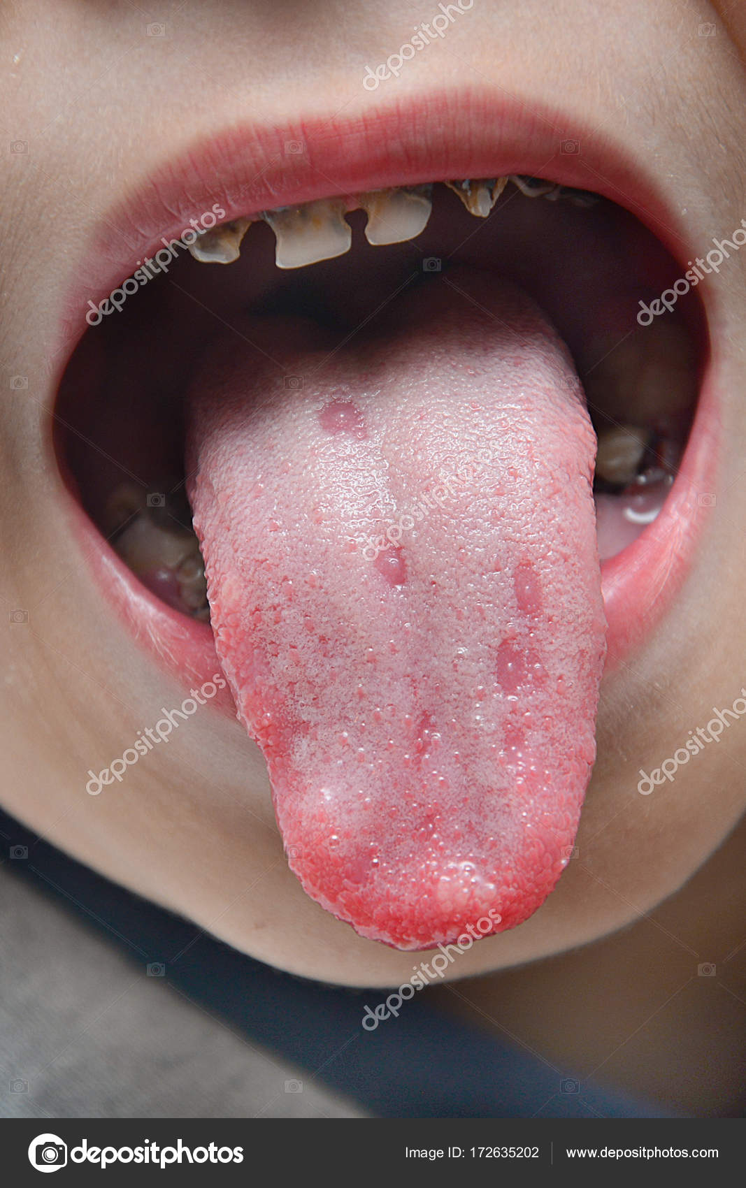Blisters on tongue child deals