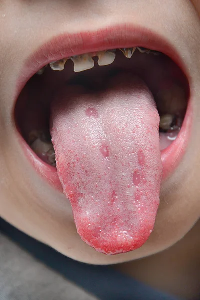 Язик Виразками Язика Після Хвороби Немовляти Ліцензійні Стокові Фото