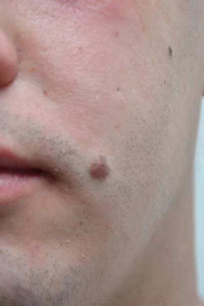 Close up of mole or birthmark on the skin , birthmark removal concept.