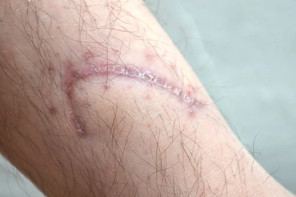 Pierna Humana Con Cicatriz Postoperatoria Cirugía Cardíaca Concepto Médico Enfermedad — Foto de Stock