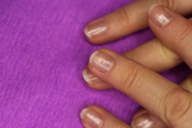 Düzgün bakımlı olmayan tırnakların maniküre ve pedikür fotoğrafına ihtiyacı var.