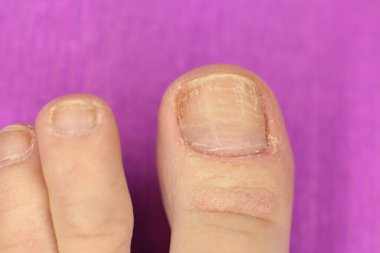 Düzgün bakımlı olmayan tırnakların maniküre ve pedikür fotoğrafına ihtiyacı var.