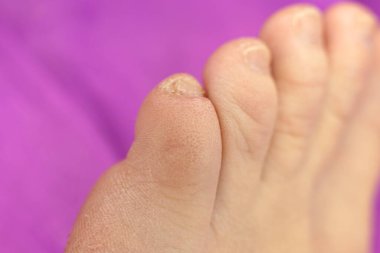 Düzgün bakımlı olmayan tırnakların maniküre ve pedikür fotoğrafına ihtiyacı var.