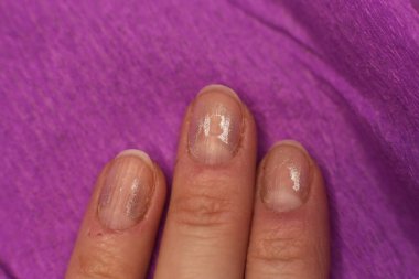 Düzgün bakımlı olmayan tırnakların maniküre ve pedikür fotoğrafına ihtiyacı var.