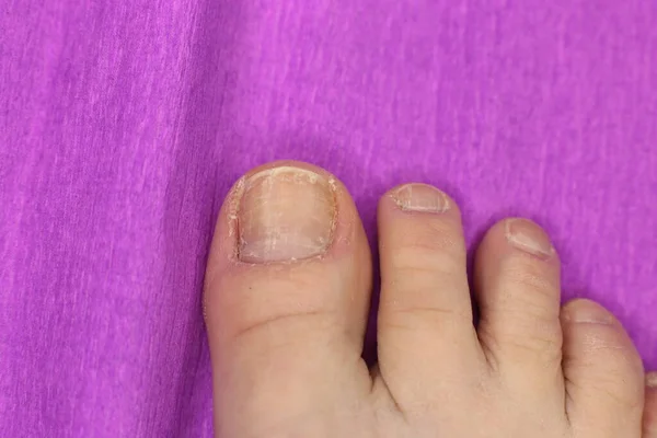 Niet Goed Verzorgde Slordige Nagels Nodig Manicure Pedicure Macro Foto — Stockfoto