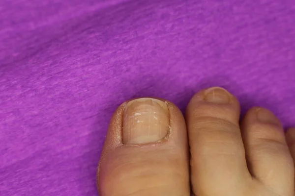 Unhas Desleixadas Não Bem Tratadas Precisam Manicure Pedicure Foto Macro — Fotografia de Stock