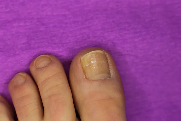 Niet Goed Verzorgde Slordige Nagels Nodig Manicure Pedicure Macro Foto — Stockfoto