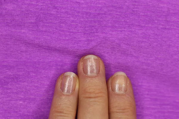 Nie Zadbane Niechlujne Paznokcie Potrzebują Manicure Pedicure Makro Zdjęcie — Zdjęcie stockowe