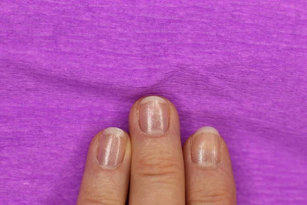 Well Groomed Sloppy Nails Need Manicure Pedicure Macro Photo — Stock Photo, Image