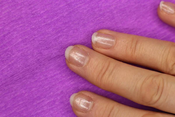 Well Groomed Sloppy Nails Need Manicure Pedicure Macro Photo — Stock Photo, Image