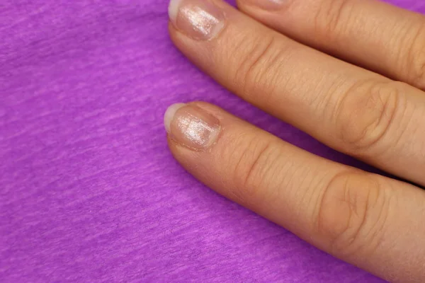 Well Groomed Sloppy Nails Need Manicure Pedicure Macro Photo — Stock Photo, Image