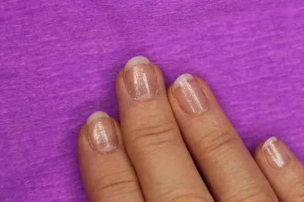 Well Groomed Sloppy Nails Need Manicure Pedicure Macro Photo — Stock Photo, Image