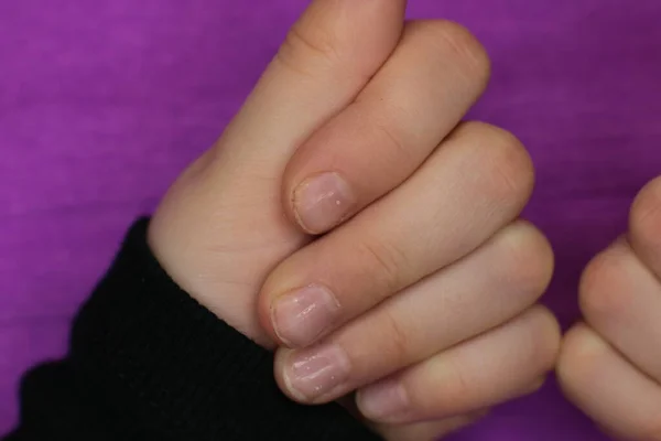 Well Groomed Sloppy Nails Need Manicure Pedicure Macro Photo — Stock Photo, Image